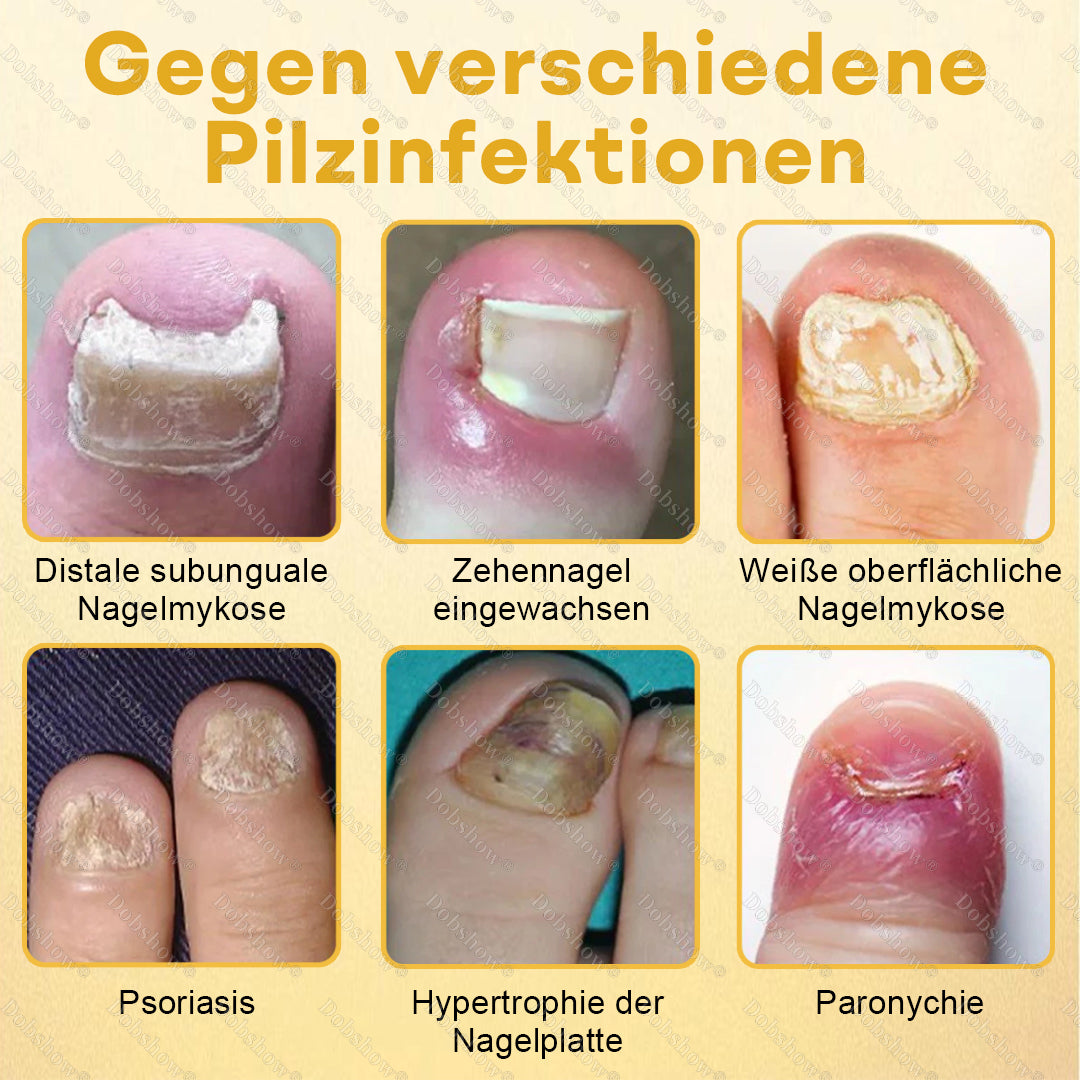 Healrize® Bienengift Nagel-Repair-Spray