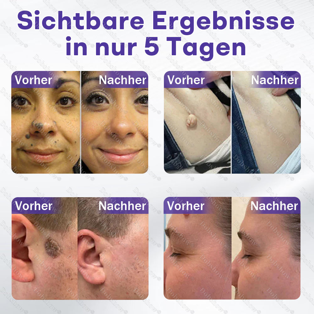 Dobshow® Mikronadelpflaster gegen Warzen und Muttermale
