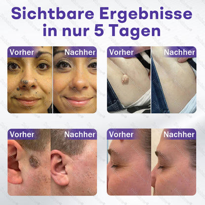 Dobshow® Mikronadelpflaster gegen Warzen und Muttermale