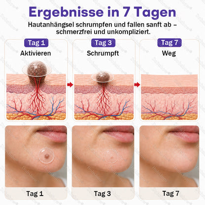 Dobshow® Mikronadelpflaster gegen Warzen und Muttermale
